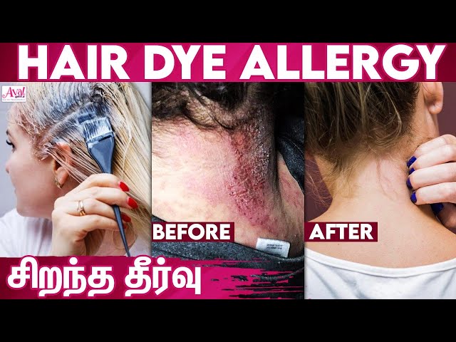 Hair Dye நீண்ட காலமாக பயன்படுத்துபவரா? | Treat Hair Dye Allergies at Home
