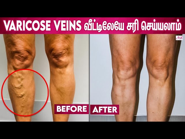 Home Treatment for Varicose Veins | GET RID OF VARICOSE VEINS, Healthy Lifestyle