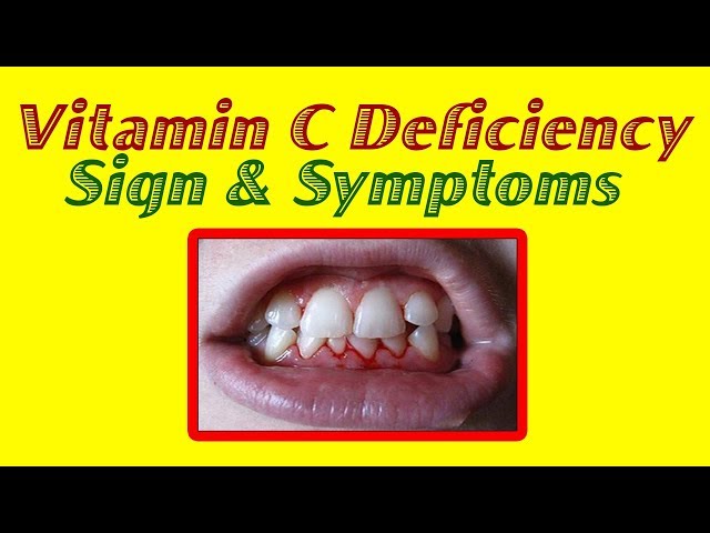 Vitamin C : Top 10 Signs and Symptoms of Vitamin C Deficiency