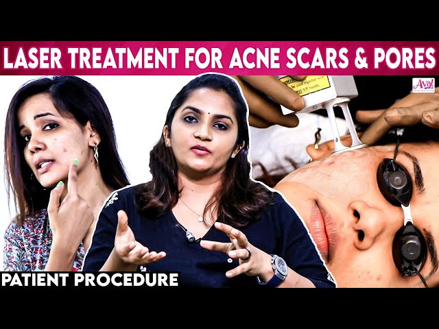 How to remove Acne Scares | Skin Glowing Treatment |Laser Skin Procedure |Dr.S.Krithika Ravindran