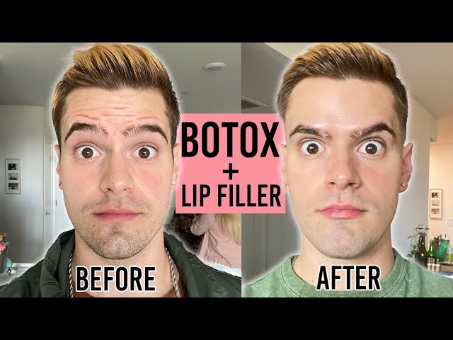 First Time Trying Botox + Filler in my 20s *HONEST REVIEW*