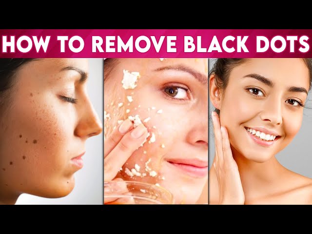 முகத்தில் உள்ள கரும்புள்ளிகள் மறைய இத செஞ்சா போதும்  : Easy Way To Remove Dark Spots In Face