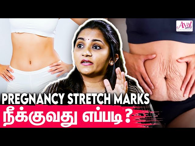 Creams மூலம் Stretch Marks ஐ சரி செய்யமுடியாது : DR Krithika Ravindran Interview | Cosmetic Surgery