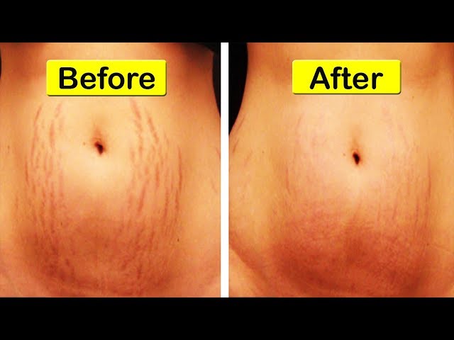 Top 10 Remedies for Stretch Marks | How to get rid of Stretch Marks