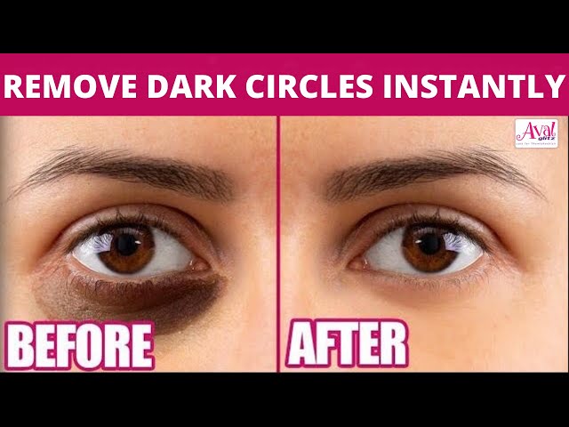 Home Remedies for Removing Dark Circles | Beauty, Avalglitz