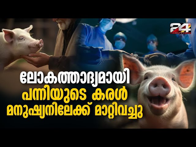 ചൈനയിൽ കരൾ അർബുദം ബാധിച്ച 71 വയസ്സുള്ള രോഗിയിലാണ് പന്നിയുടെ കരൾ മാറ്റിവച്ചത് Pig Liver Transplant