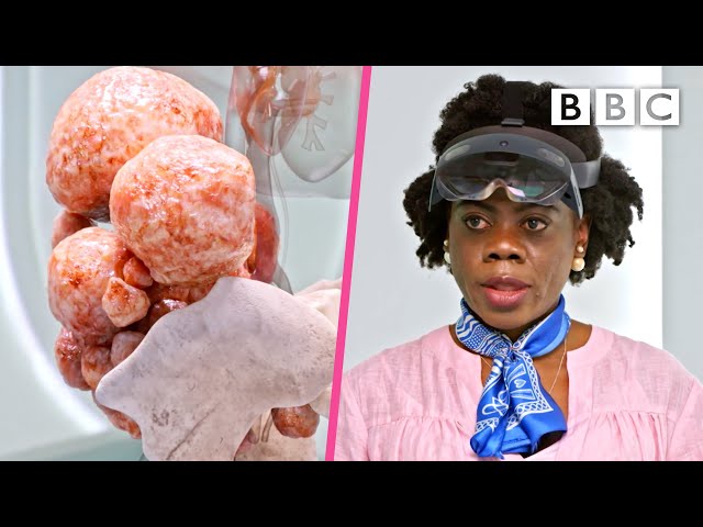 Incredible surgery to remove over 100 fibroids | Your Body Uncovered With Kate Garraway - BBC