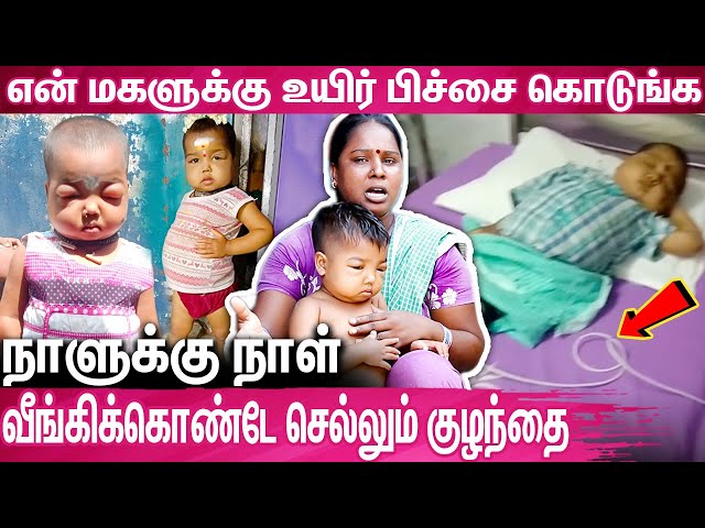குழந்தையை காப்பாற்ற தாயின் பாசப்போராட்டம் : A Baby Suffering From a Severe Disease in Chennai