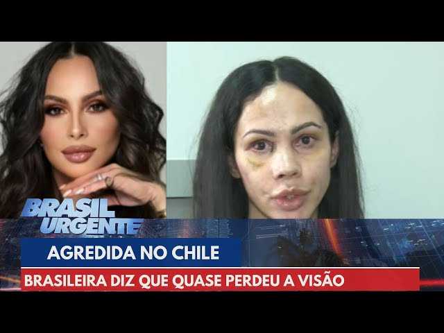 Brasileira agredida no Chile diz que quase perdeu a visão | Brasil Urgente
