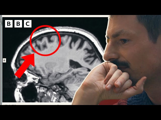 Son sees how Alzheimer's affected his mum's brain - BBC
